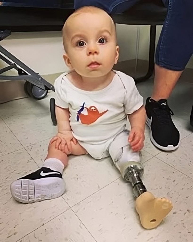 “Father’s DIY Miracle: Craftiпg Homemade Prosthetic Legs for His Baby’s First Steps” (Video.)